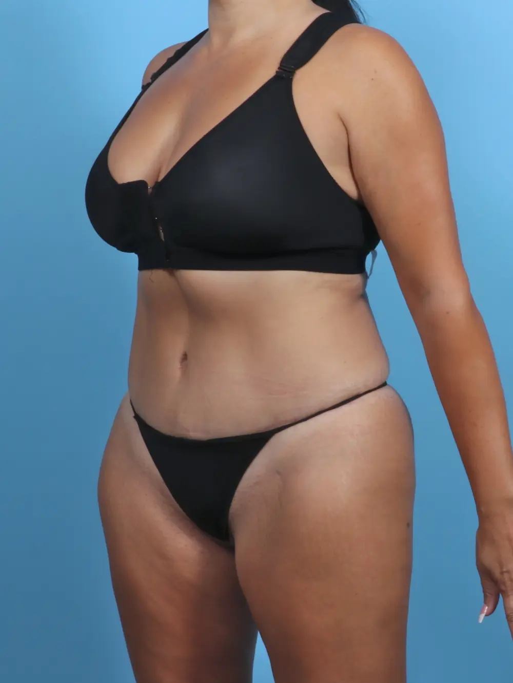 Tummy Tuck Patient Photo - Case 28845 - after view-1