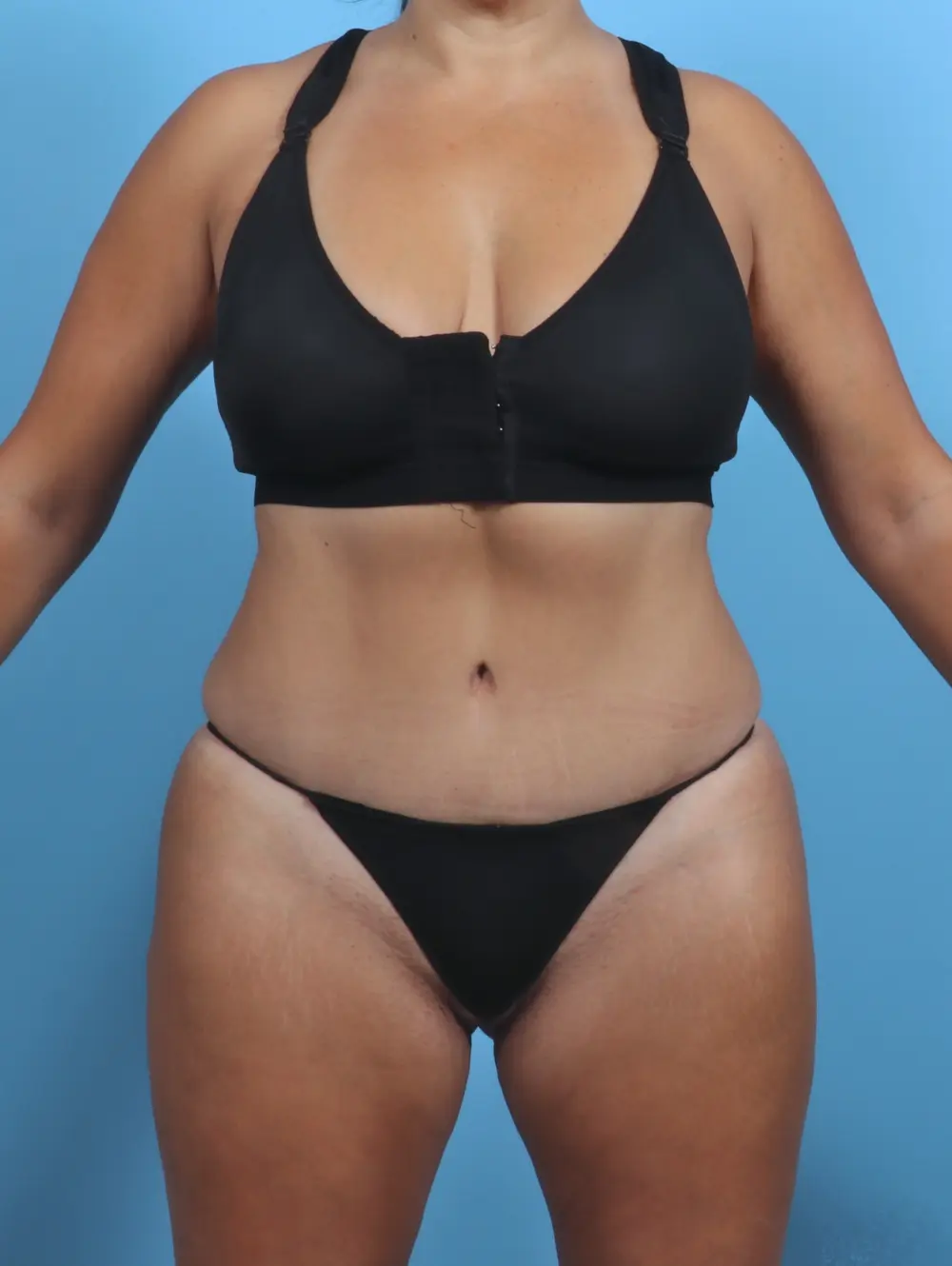 Tummy Tuck Patient Photo - Case 28845 - after view