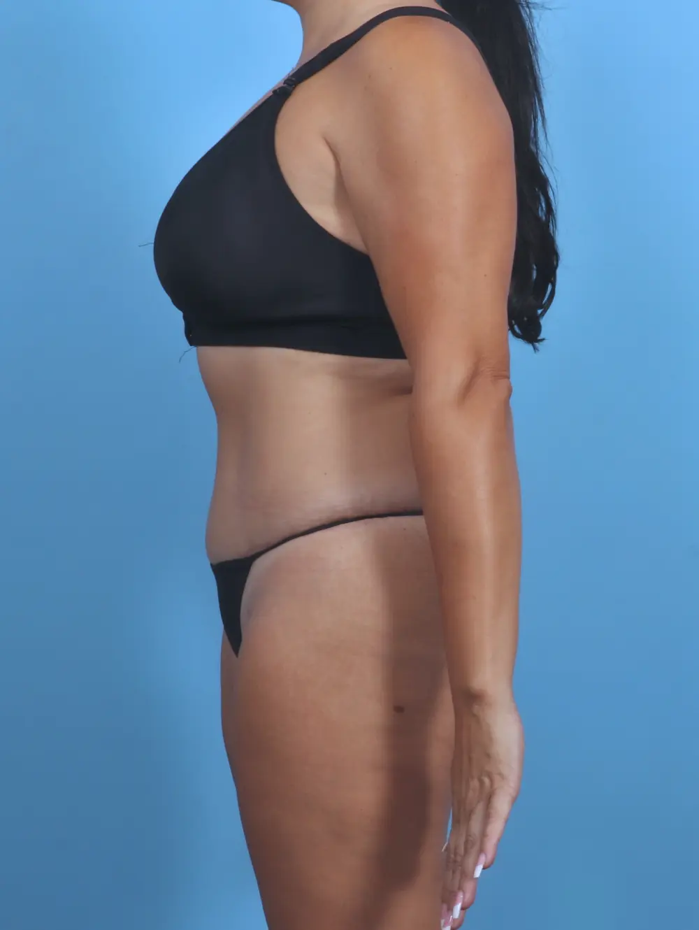Tummy Tuck Patient Photo - Case 28845 - after view-2