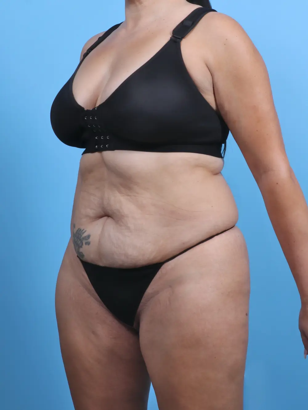 Tummy Tuck Patient Photo - Case 28845 - before view-1