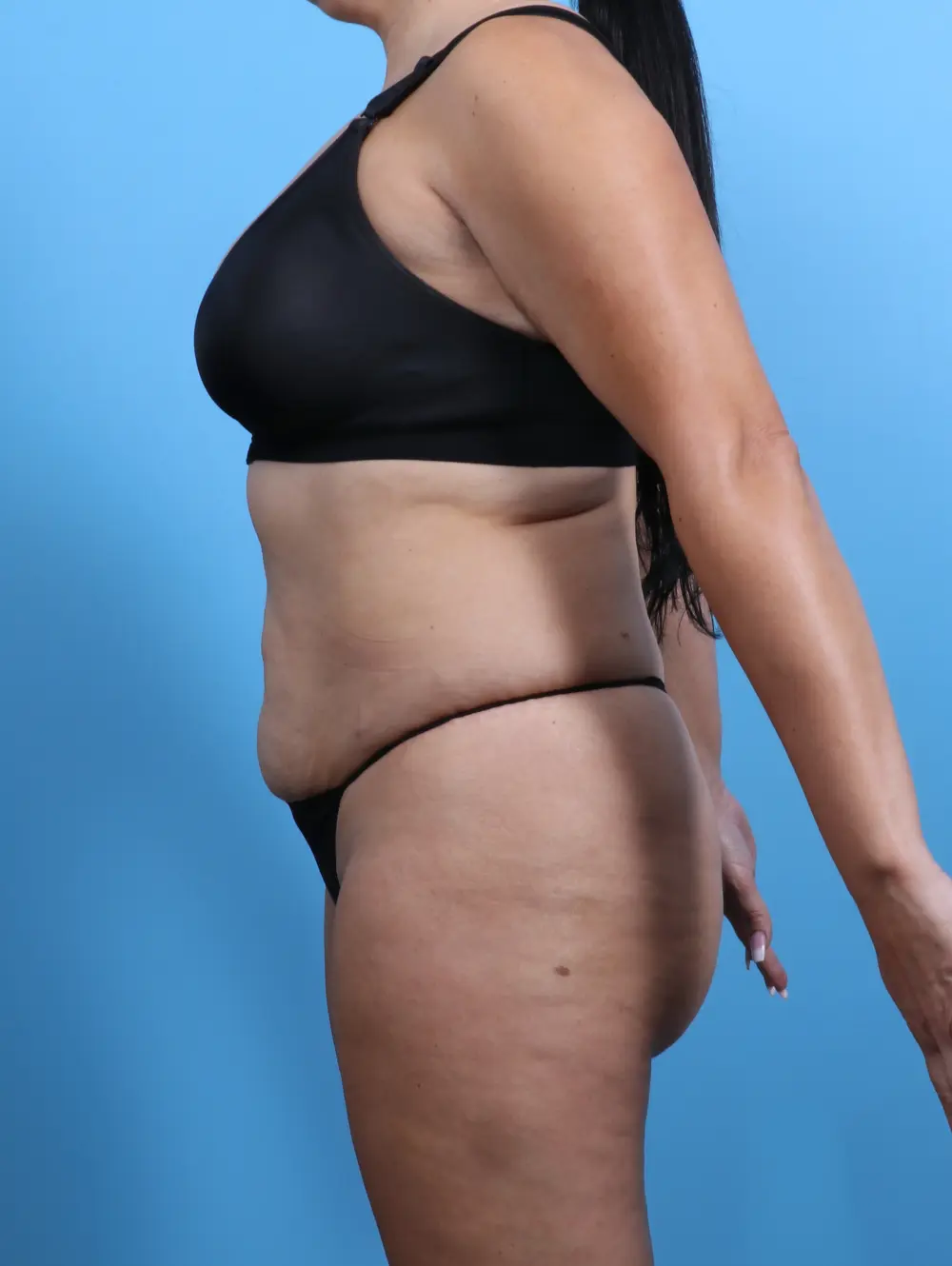 Tummy Tuck Patient Photo - Case 28845 - before view-2