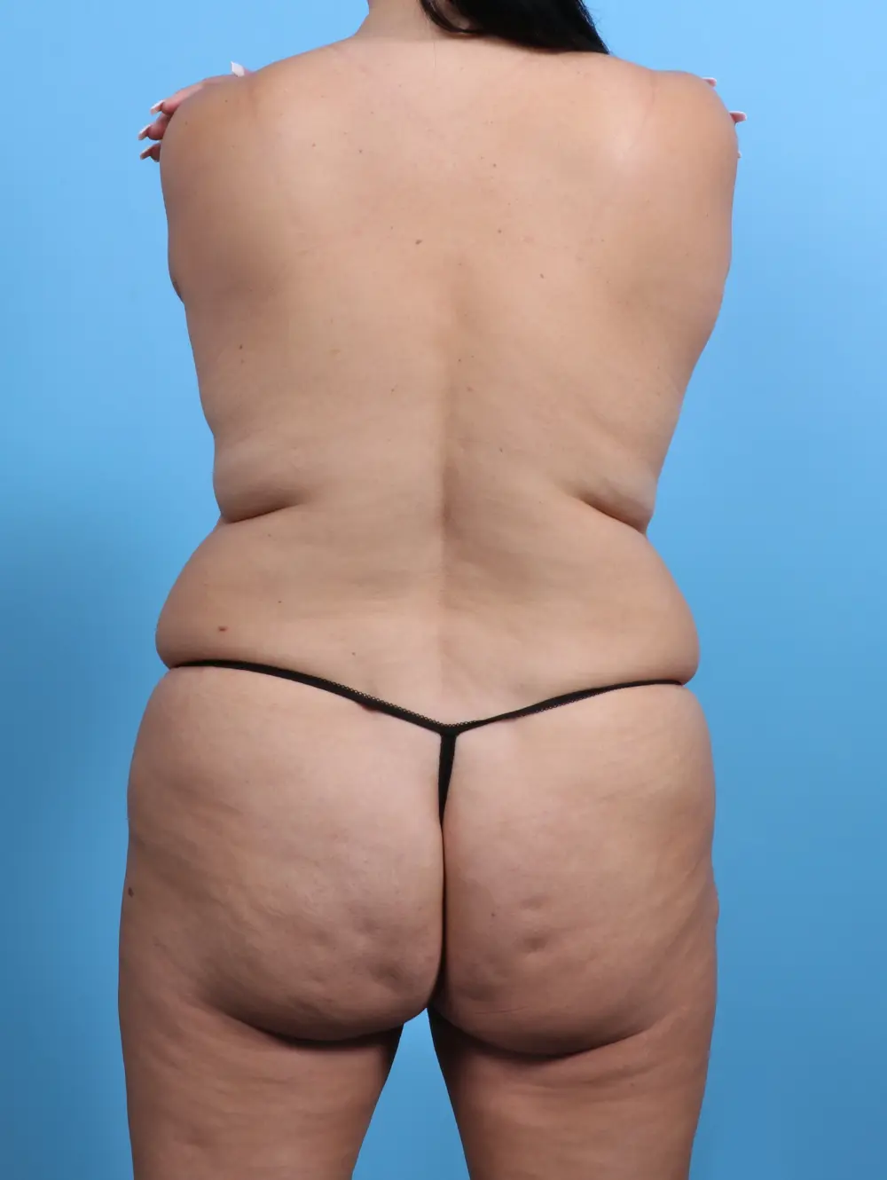 Tummy Tuck Patient Photo - Case 28845 - before view-3