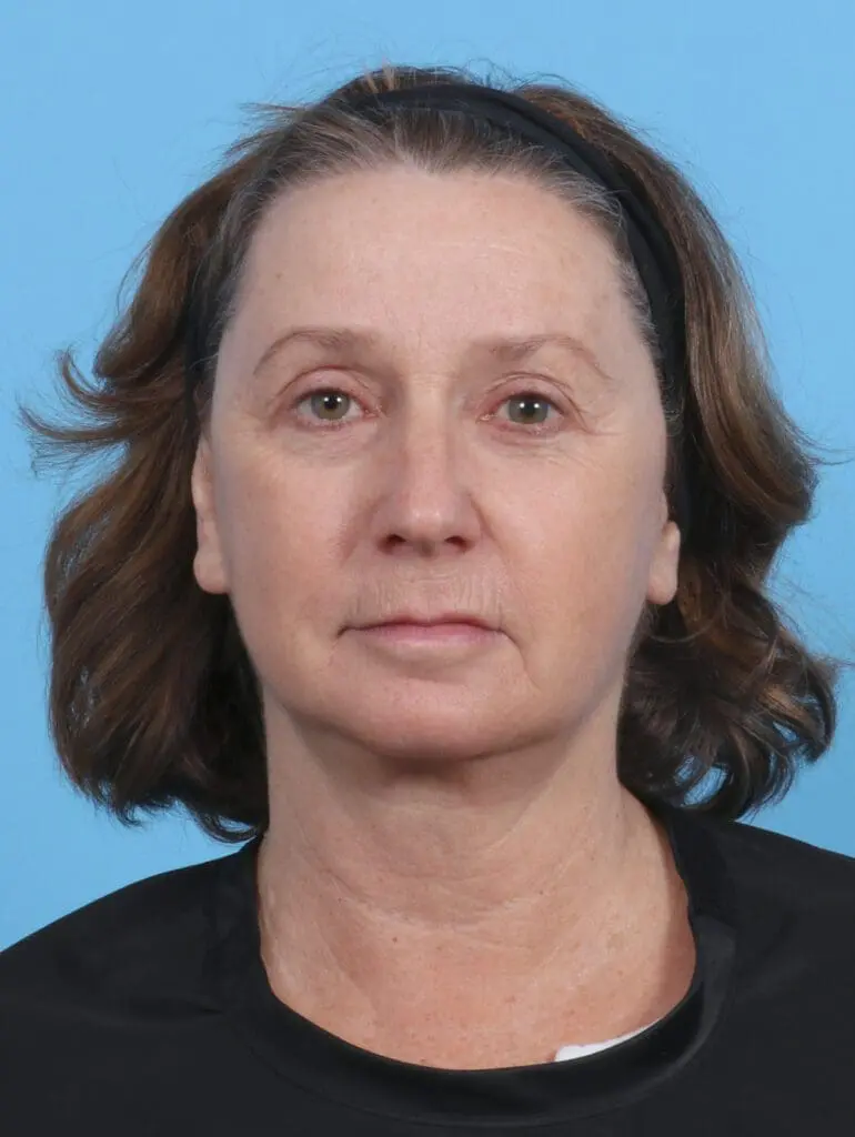 Brow Lift - Case 28873 - After