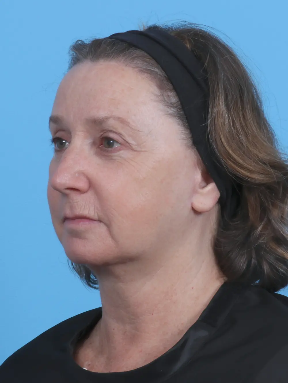 Brow Lift Patient Photo - Case 28873 - after view-1