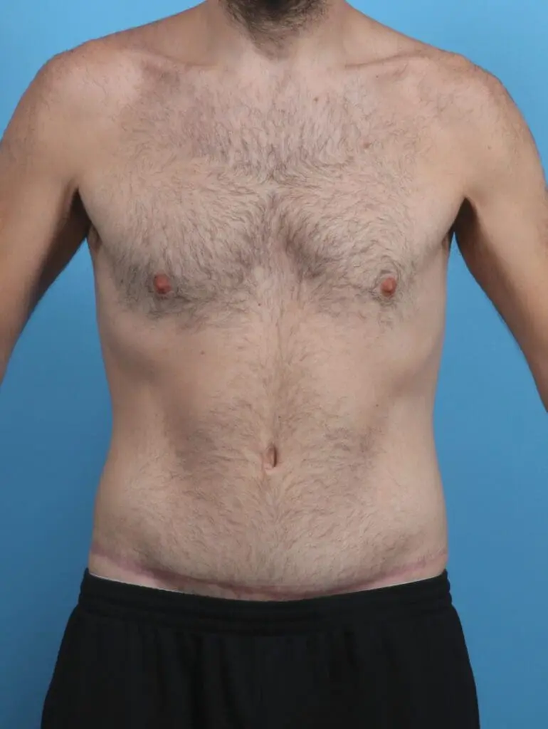 Body Lift - Case 28881 - After