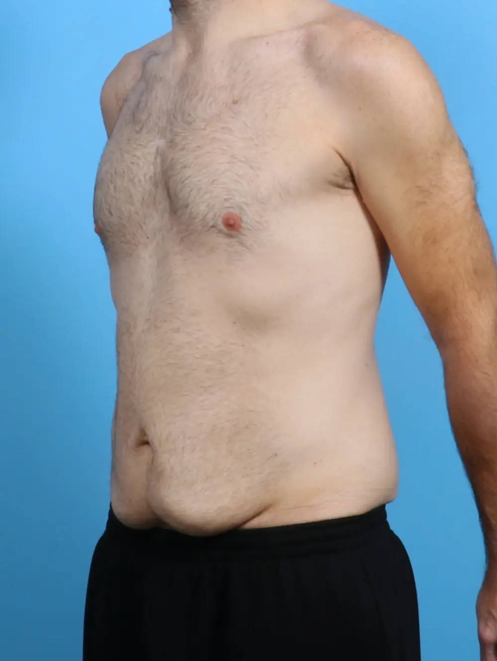 Body Lift Patient Photo - Case 28881 - before view-1