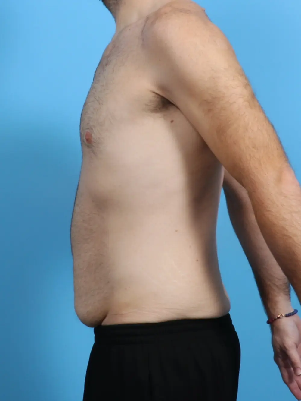 Body Lift Patient Photo - Case 28881 - before view-2