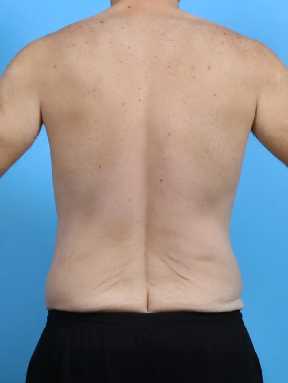Body Lift Patient Photo - Case 28881 - before view-3