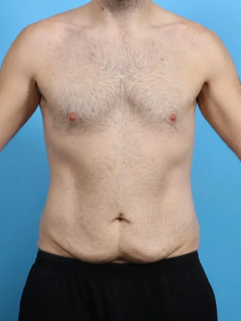 Body Lift - Case 28881 - Before