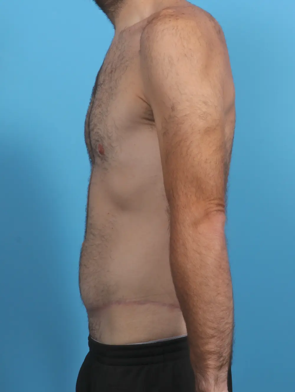 Body Lift Patient Photo - Case 28881 - after view-2