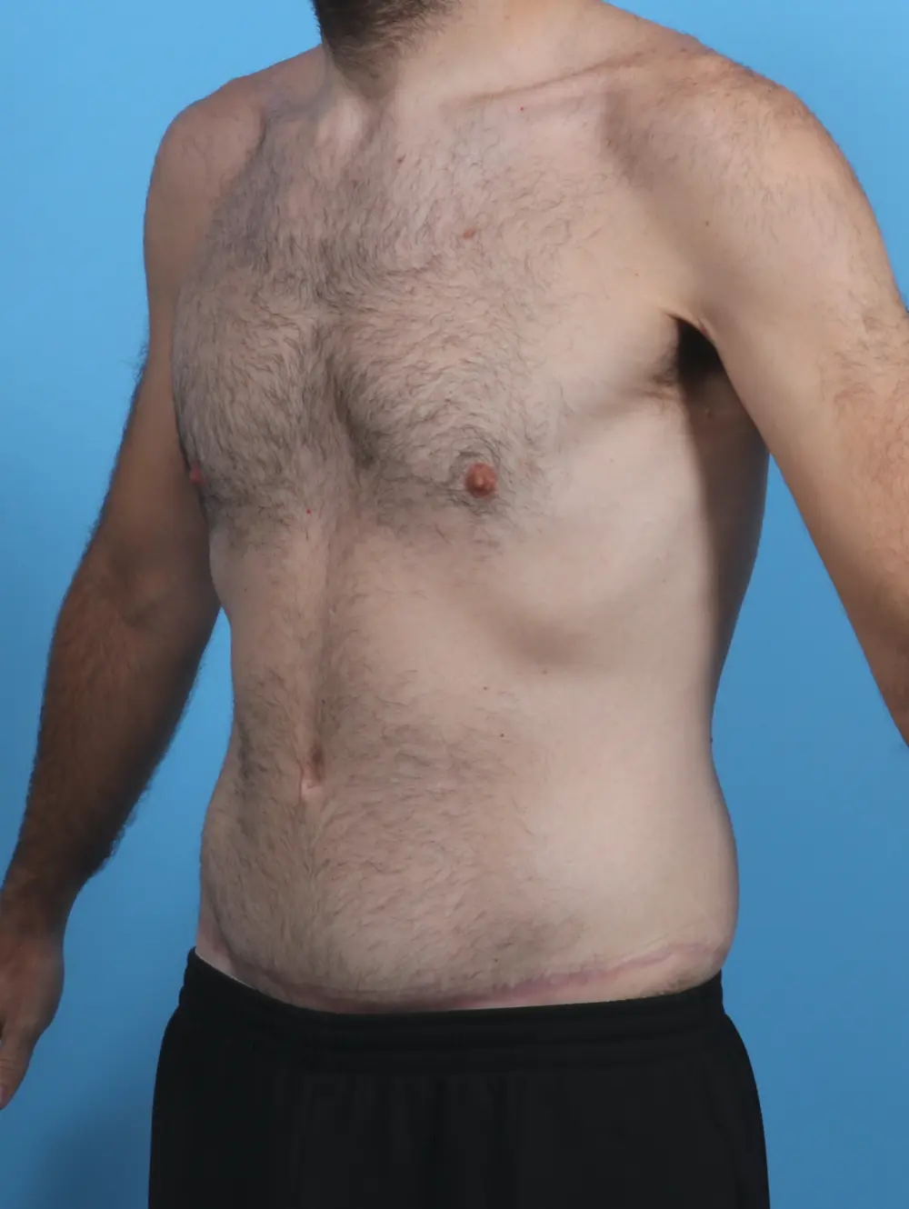 Body Lift Patient Photo - Case 28881 - after view-1