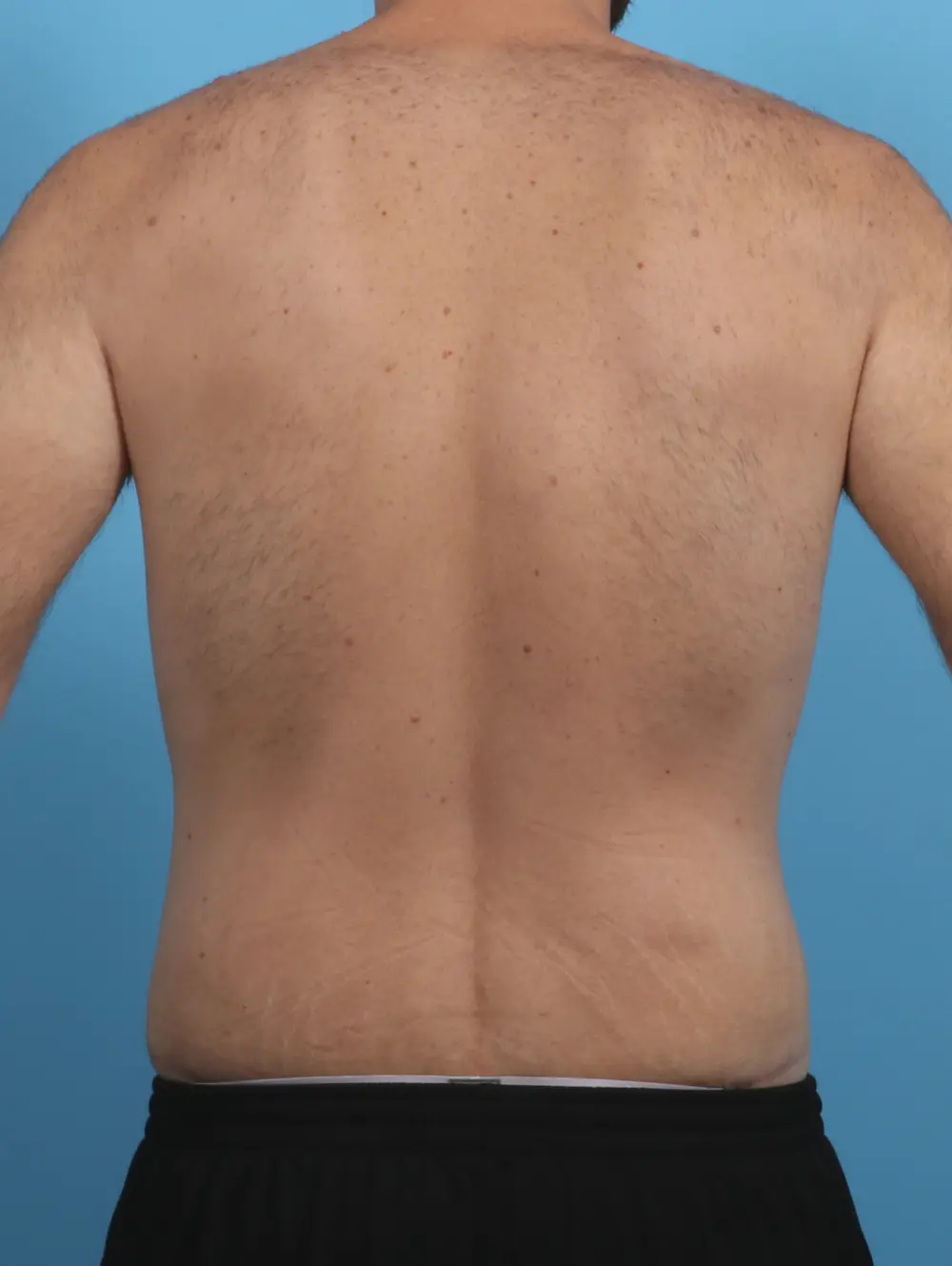 Body Lift Patient Photo - Case 28881 - after view-3