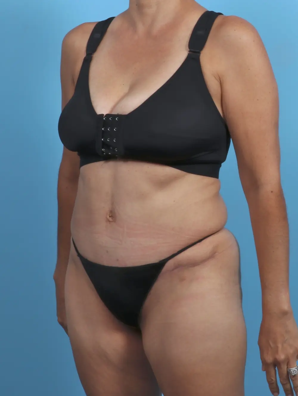 Tummy Tuck Patient Photo - Case 28909 - after view-1