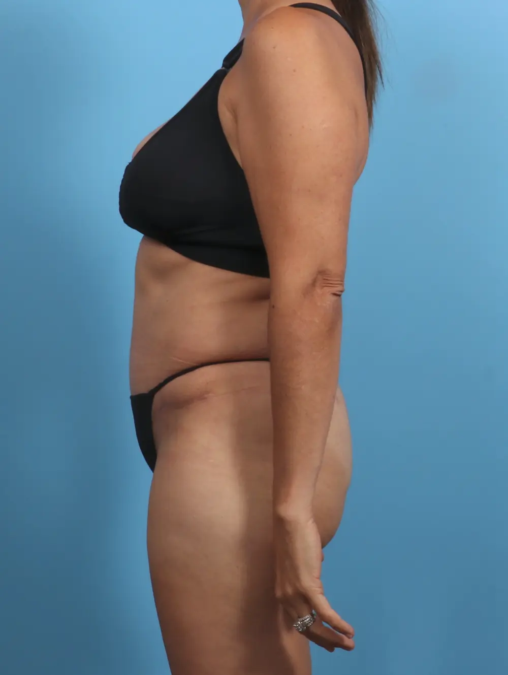 Tummy Tuck Patient Photo - Case 28909 - after view-2