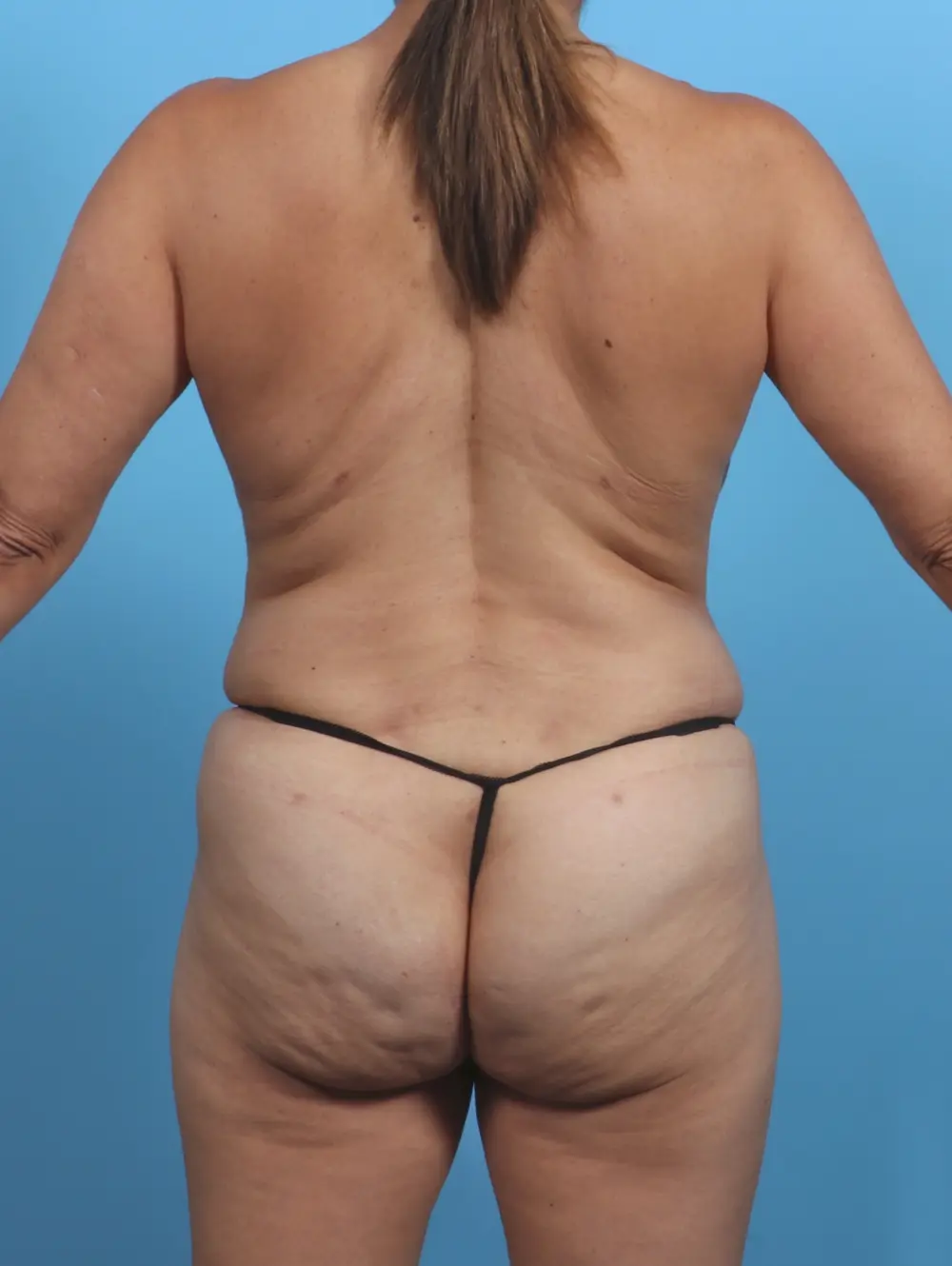 Tummy Tuck Patient Photo - Case 28909 - after view-3