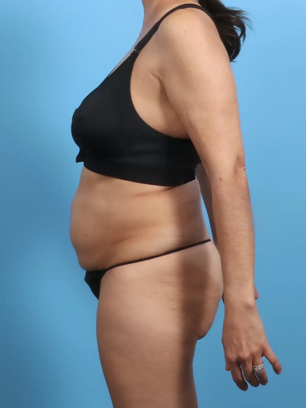 Tummy Tuck Patient Photo - Case 28909 - before view-2