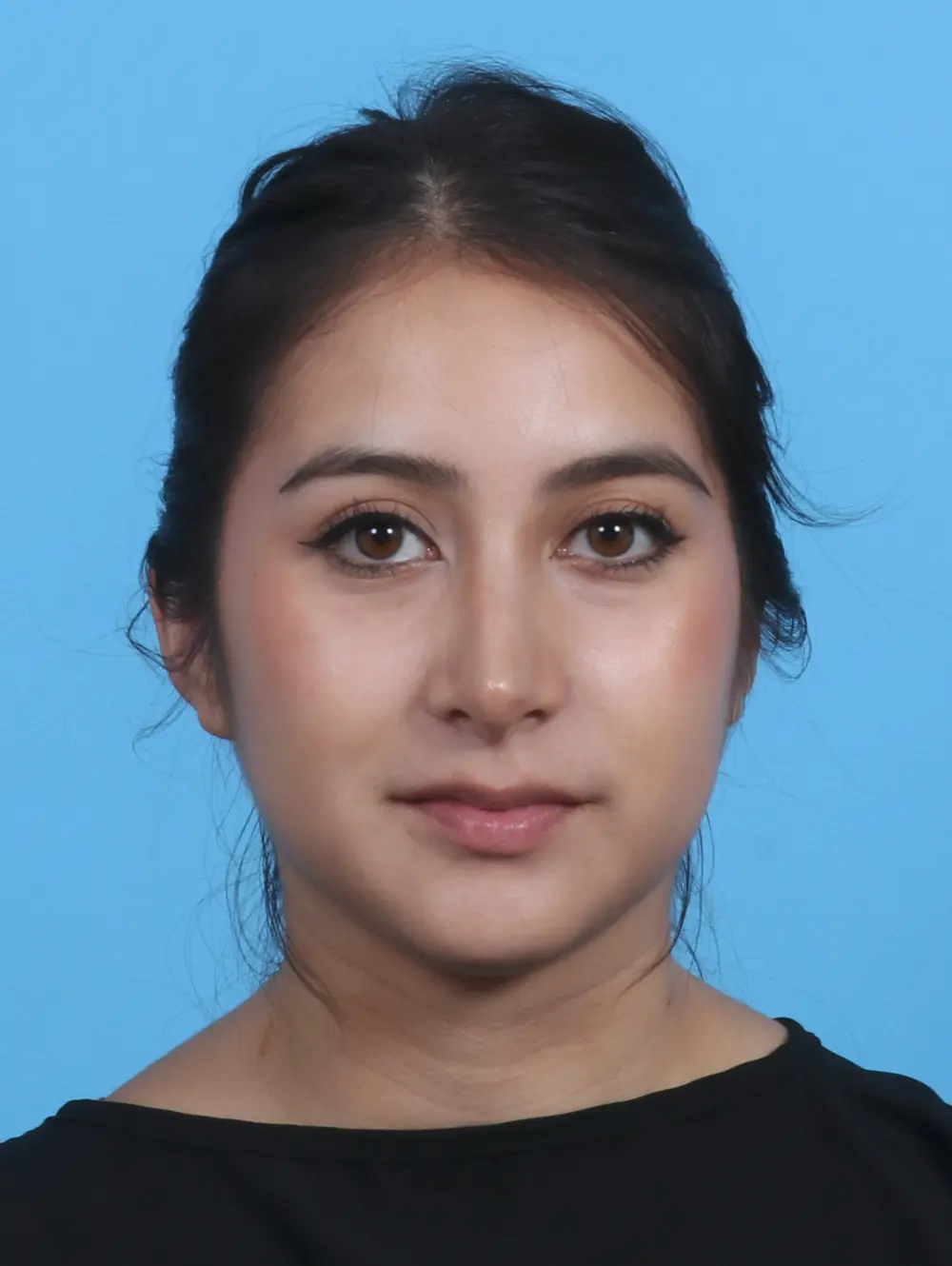 Rhinoplasty Patient Photo - Case 28927 - after view-2