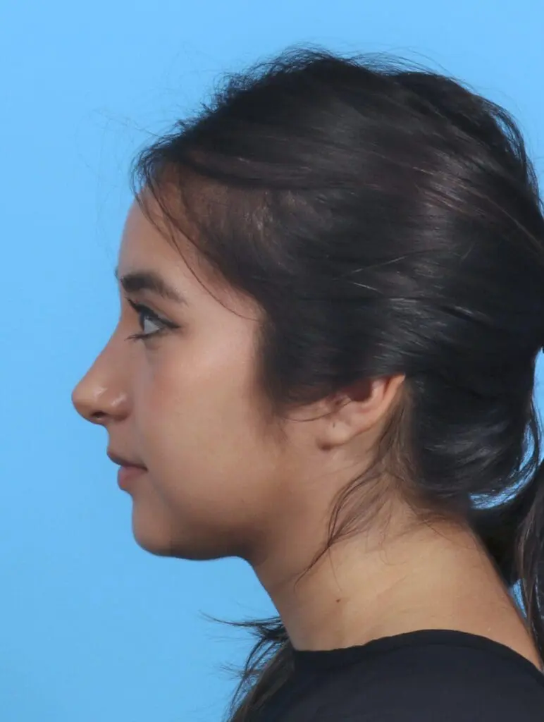 Rhinoplasty - Case 28927 - After