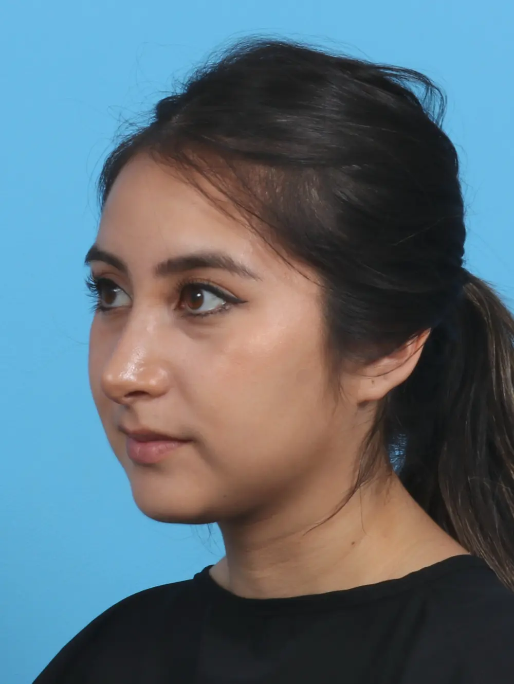 Rhinoplasty Patient Photo - Case 28927 - after view-1