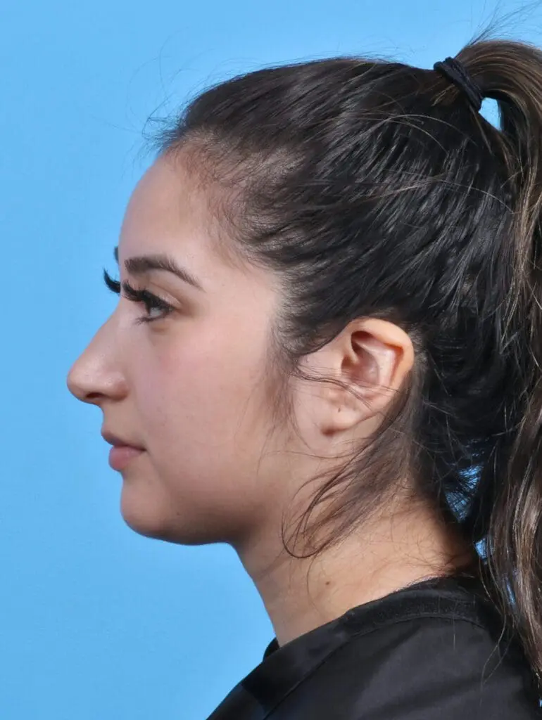 Rhinoplasty - Case 28927 - Before