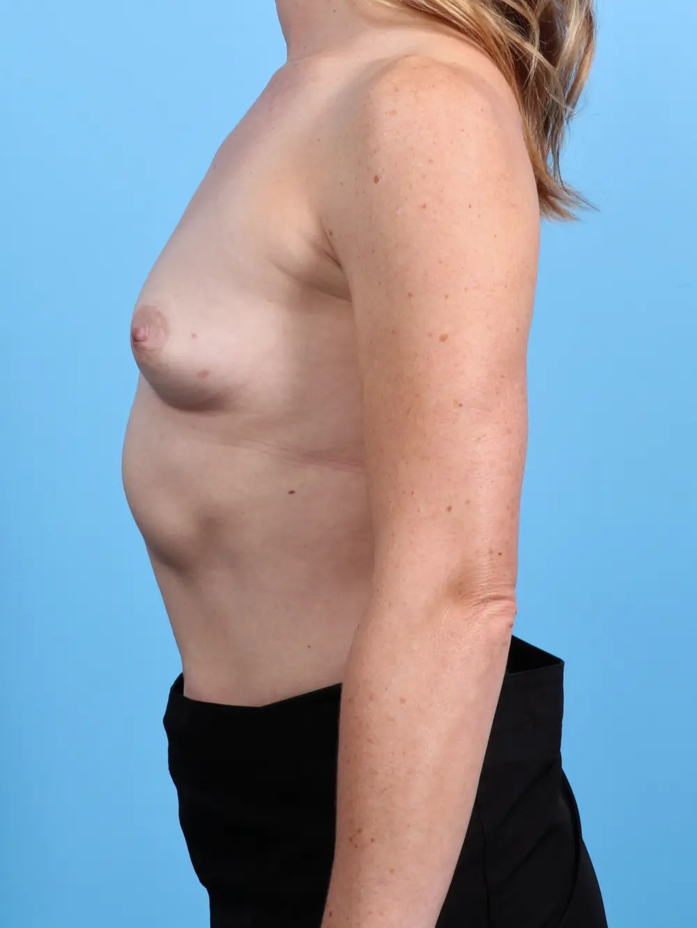 Breast Augmentation Patient Photo - Case 28936 - before view-2
