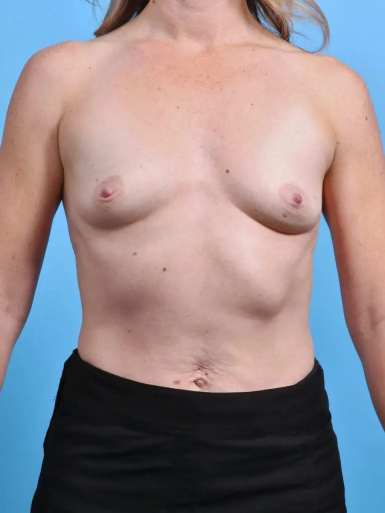 Breast Augmentation - Case 28936 - Before