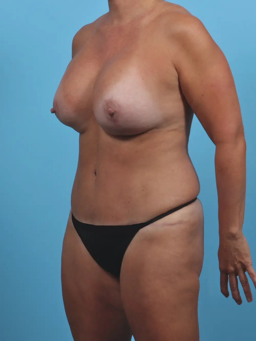 Breast Lift/Reduction with Implants Patient Photo - Case 28986 - after view-1