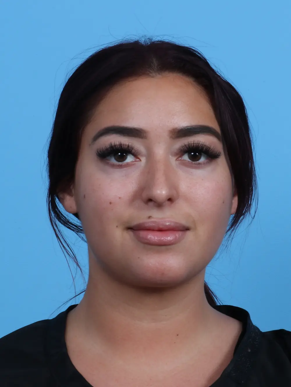 Liposuction Patient Photo - Case 29028 - after view-2