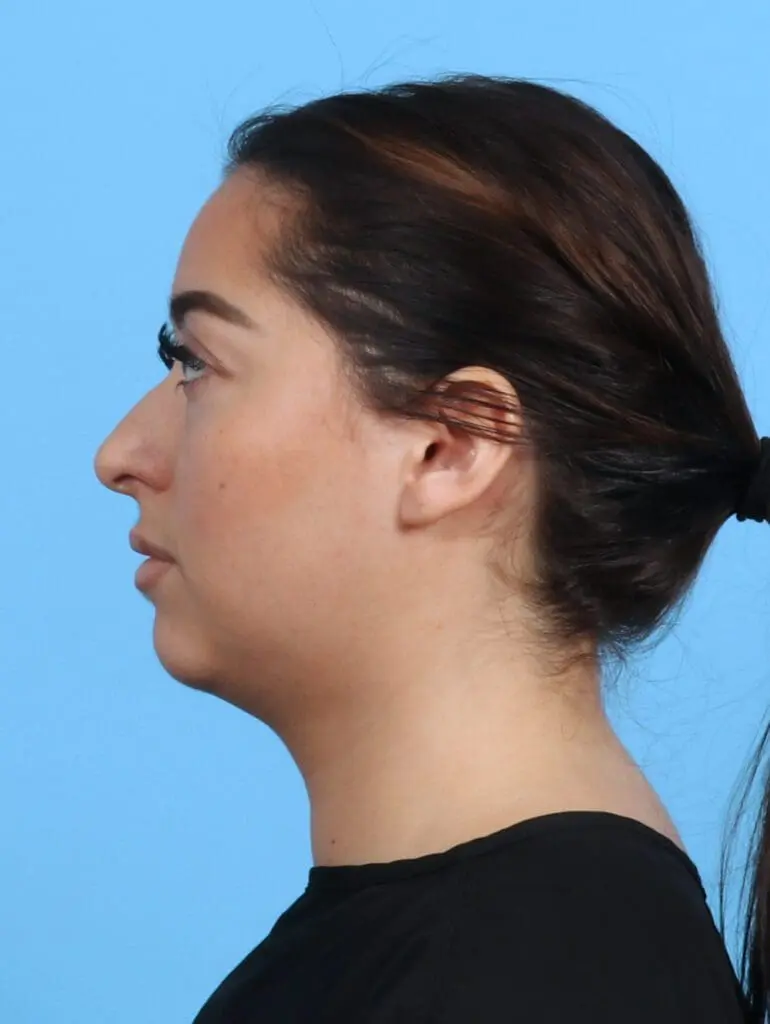 Liposuction - Case 29028 - Before