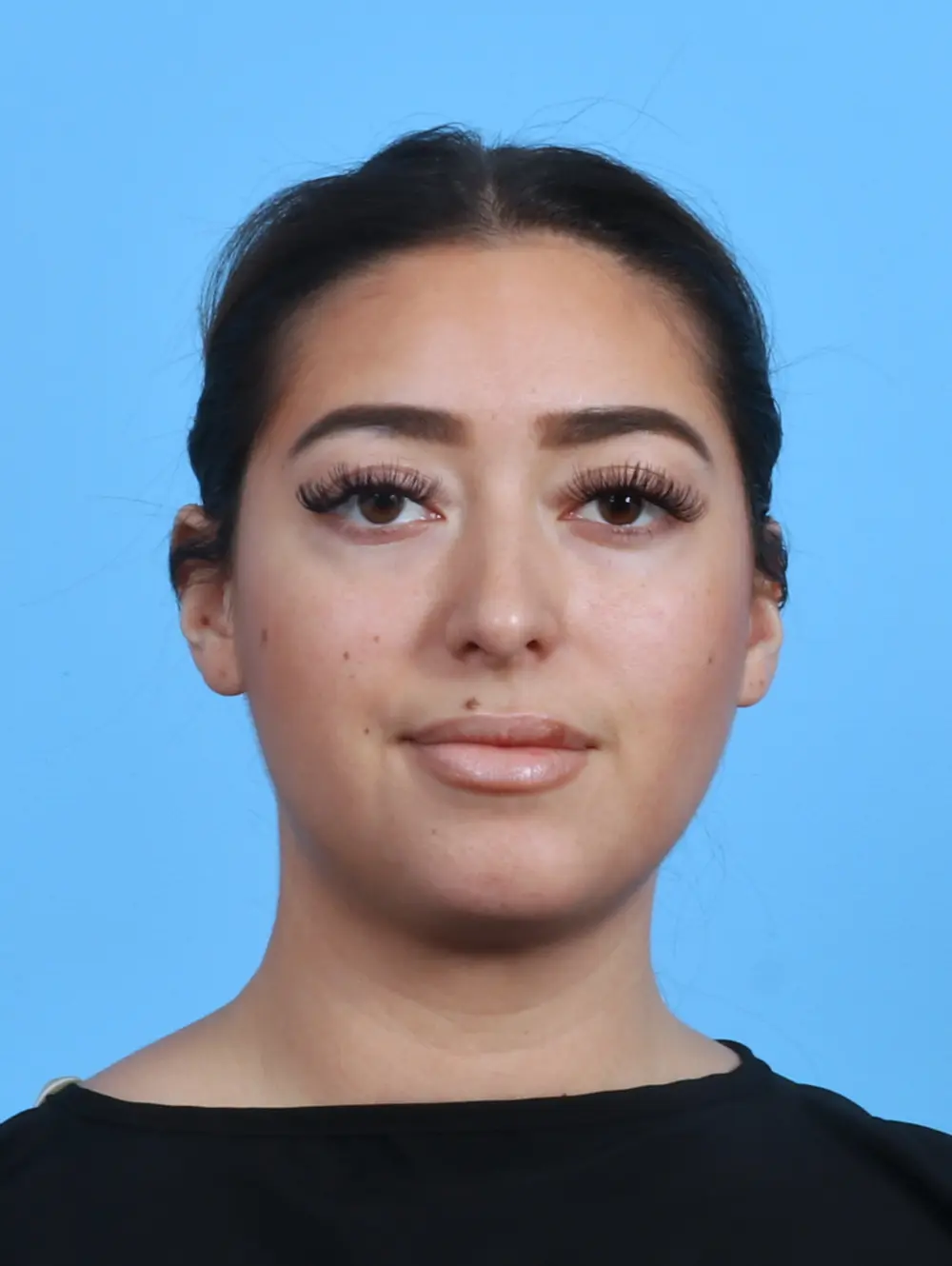 Liposuction Patient Photo - Case 29028 - before view-2