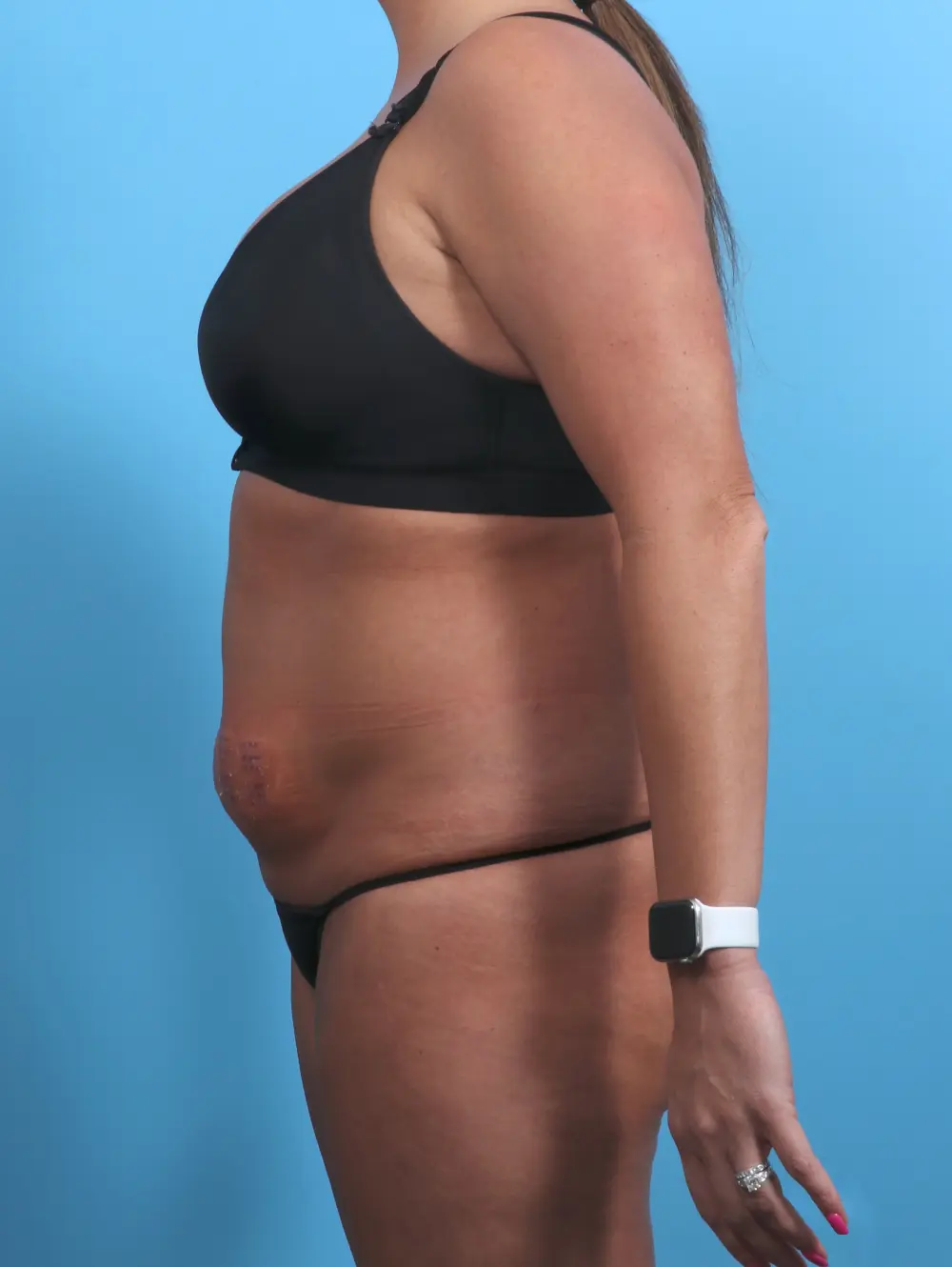 Tummy Tuck Patient Photo - Case 29057 - before view-2