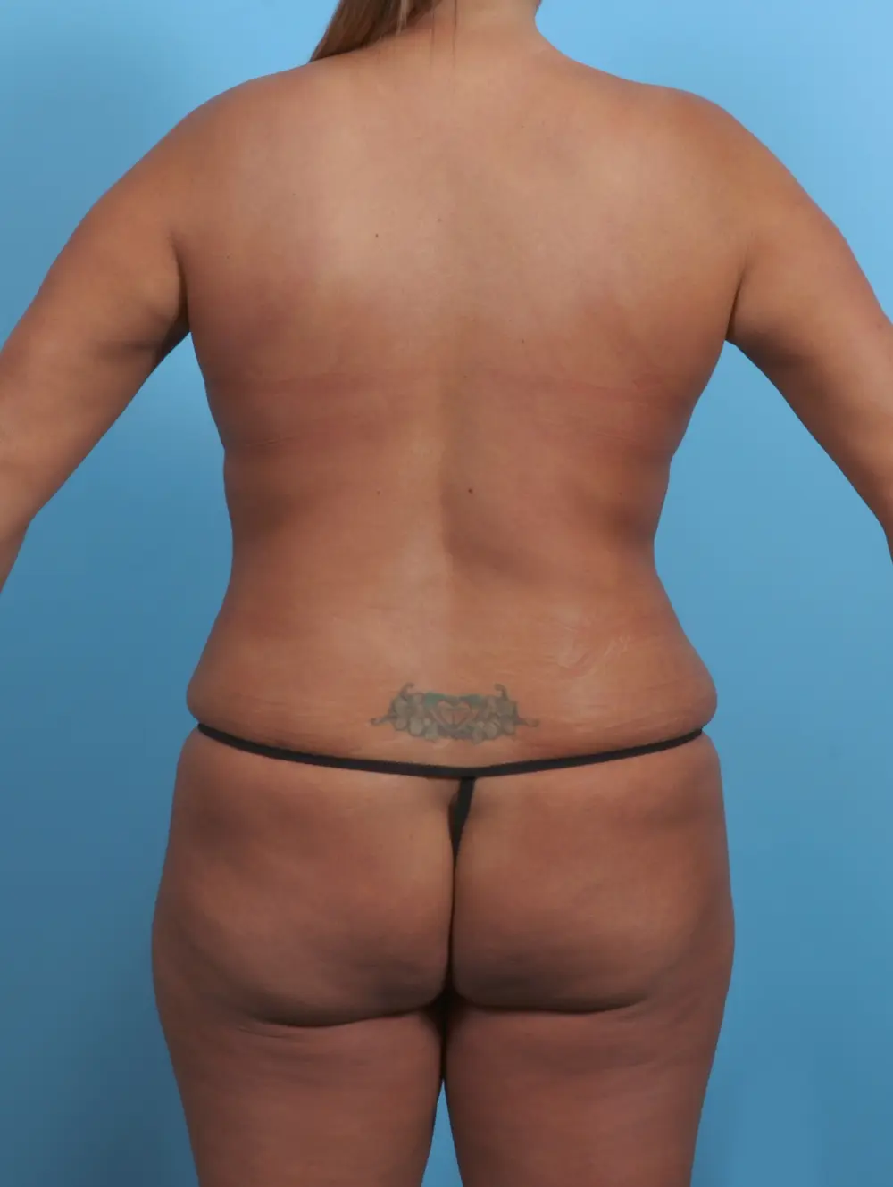 Tummy Tuck Patient Photo - Case 29057 - after view-3