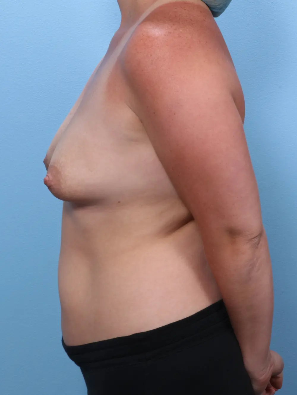 Breast Lift/Reduction with Implants Patient Photo - Case 29067 - before view-2