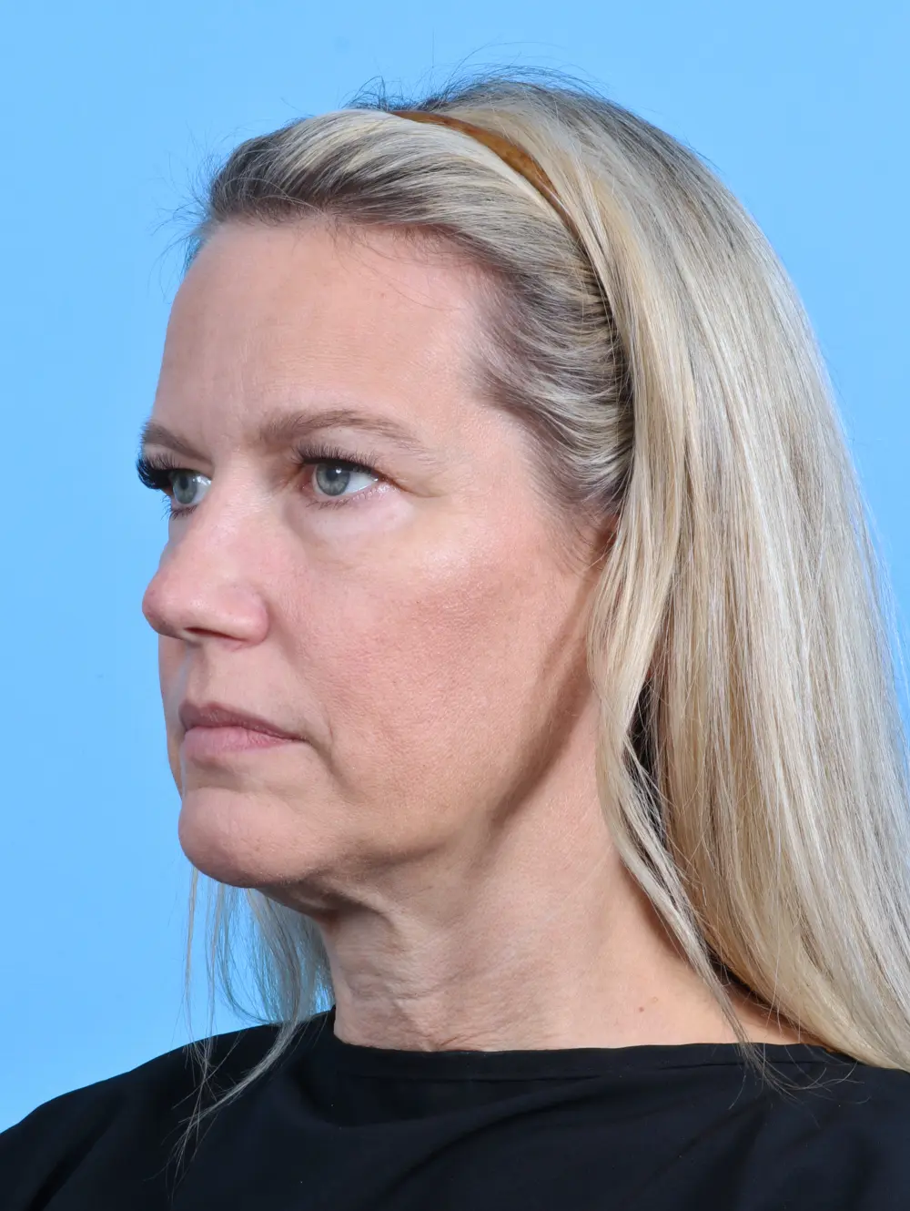 Brow Lift Patient Photo - Case 29118 - before view-1