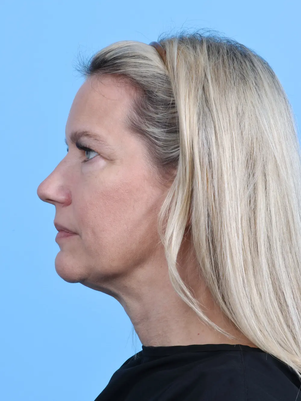 Brow Lift Patient Photo - Case 29118 - before view-2