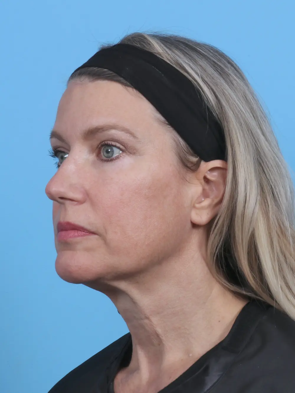 Brow Lift Patient Photo - Case 29118 - after view-1