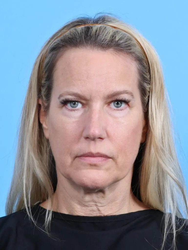 Brow Lift - Case 29118 - Before