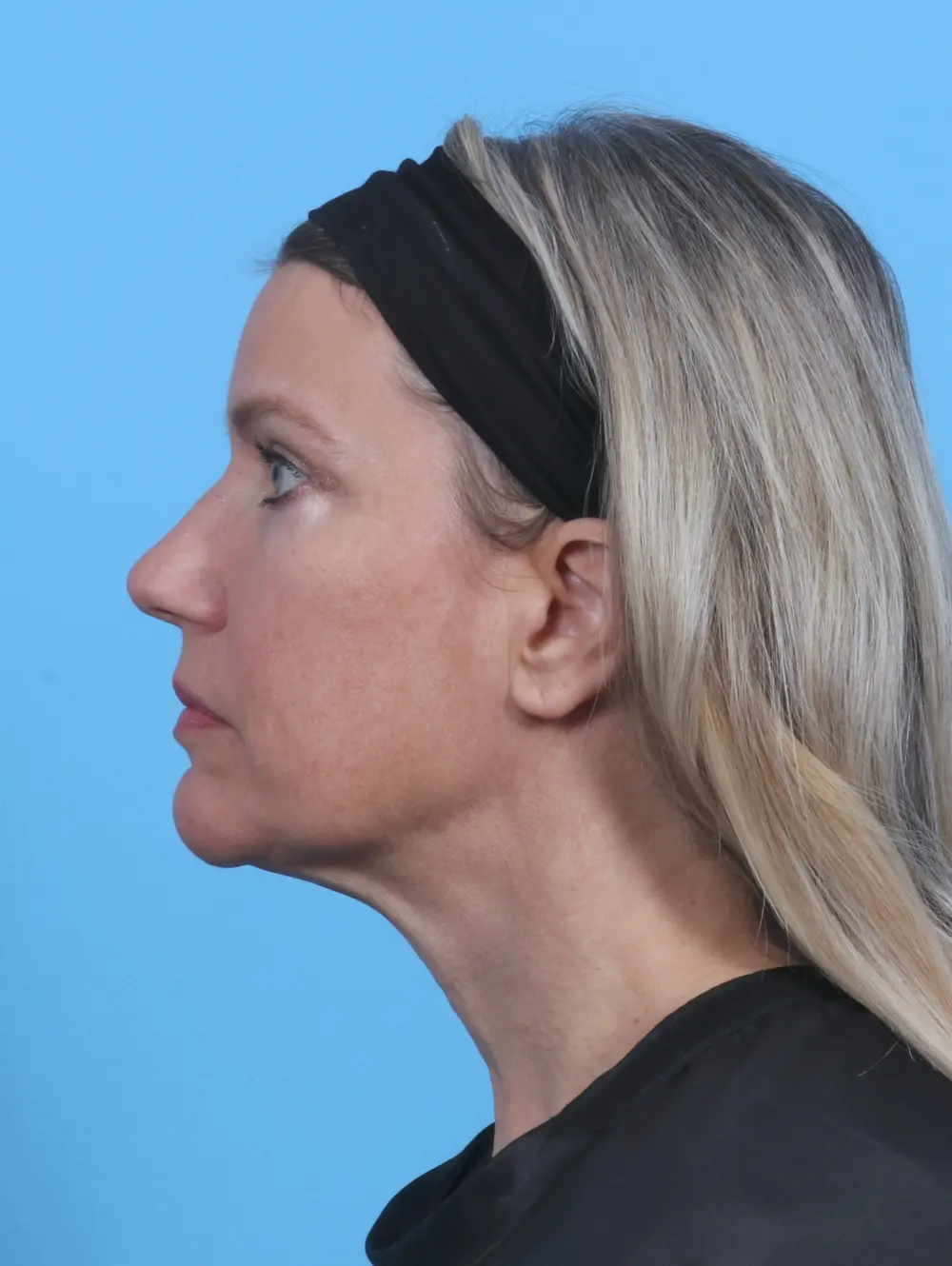 Brow Lift Patient Photo - Case 29118 - after view-2