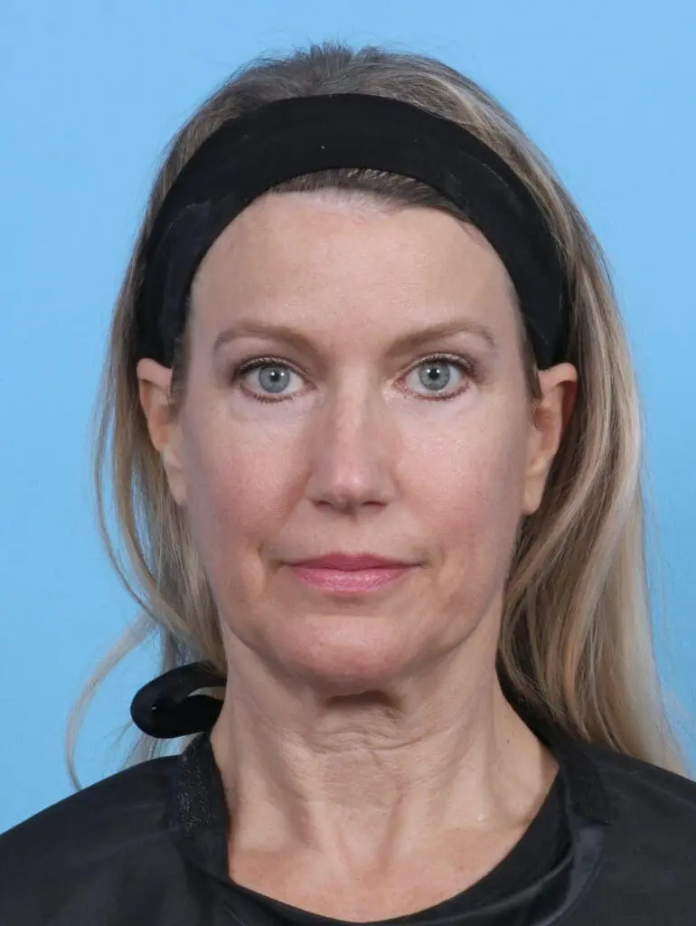 Brow Lift - Case 29118 - After