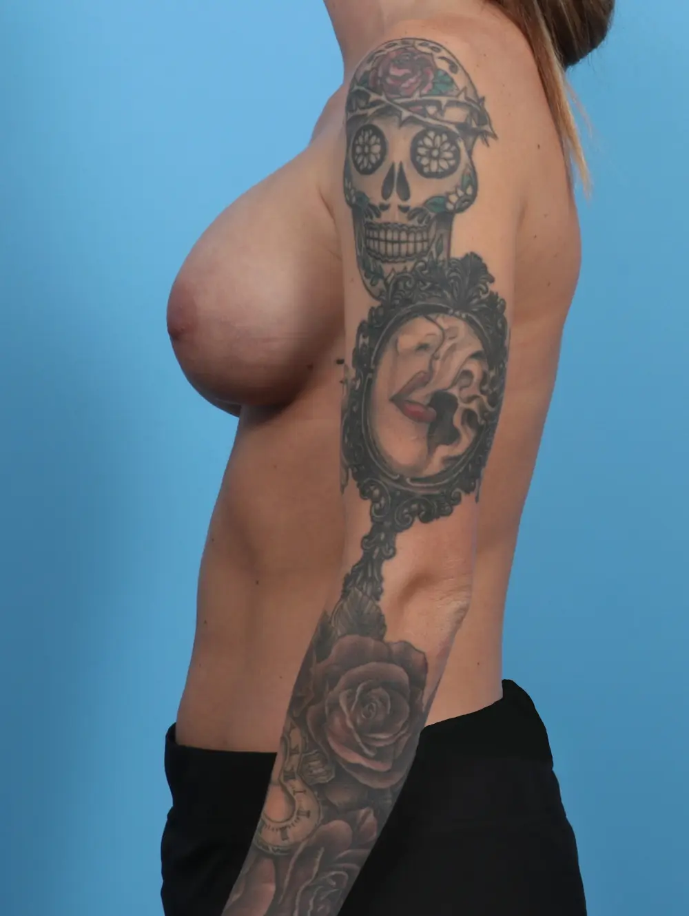 Breast Augmentation Patient Photo - Case 29126 - after view-2