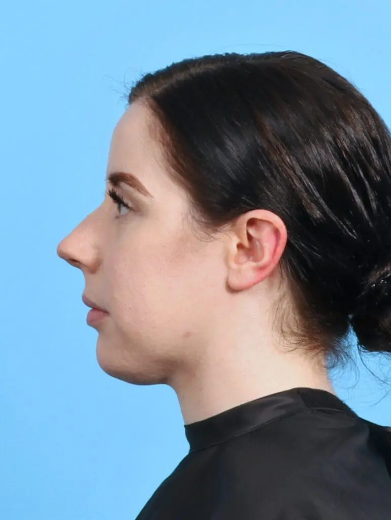 Rhinoplasty - Case 29134 - Before