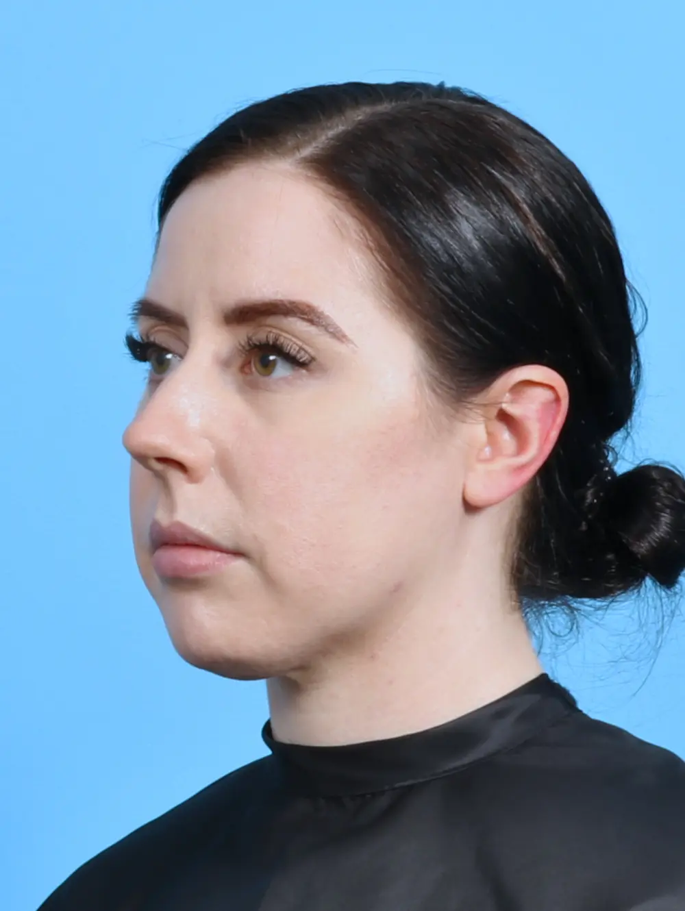 Rhinoplasty Patient Photo - Case 29134 - before view-1