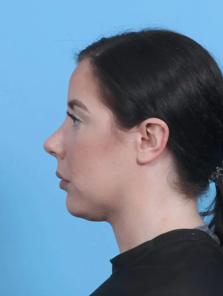 Rhinoplasty - Case 29134 - After