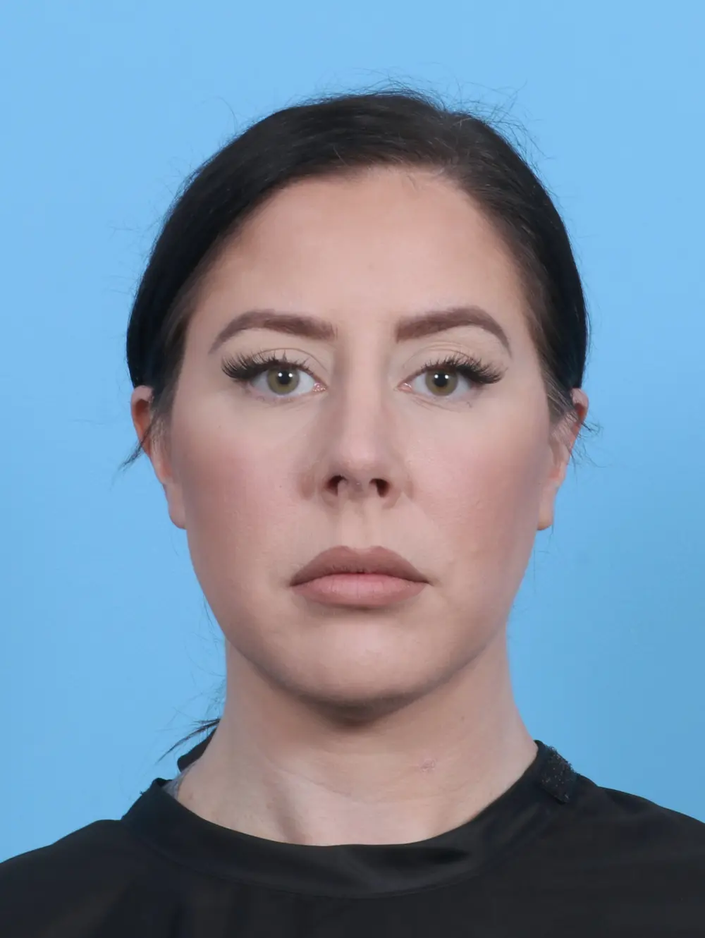 Rhinoplasty Patient Photo - Case 29134 - after view-2