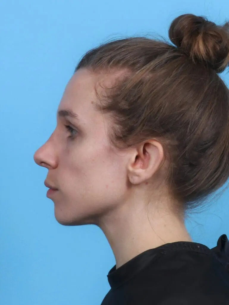 Rhinoplasty - Case 29156 - After