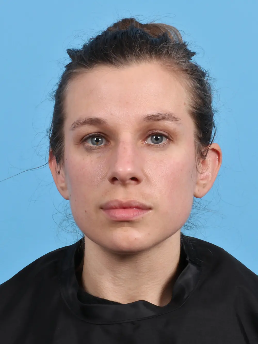 Rhinoplasty Patient Photo - Case 29156 - before view-2