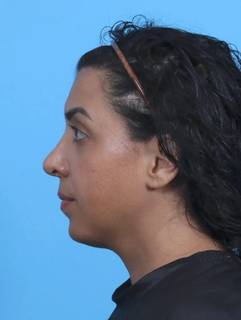 Rhinoplasty - Case 29233 - After