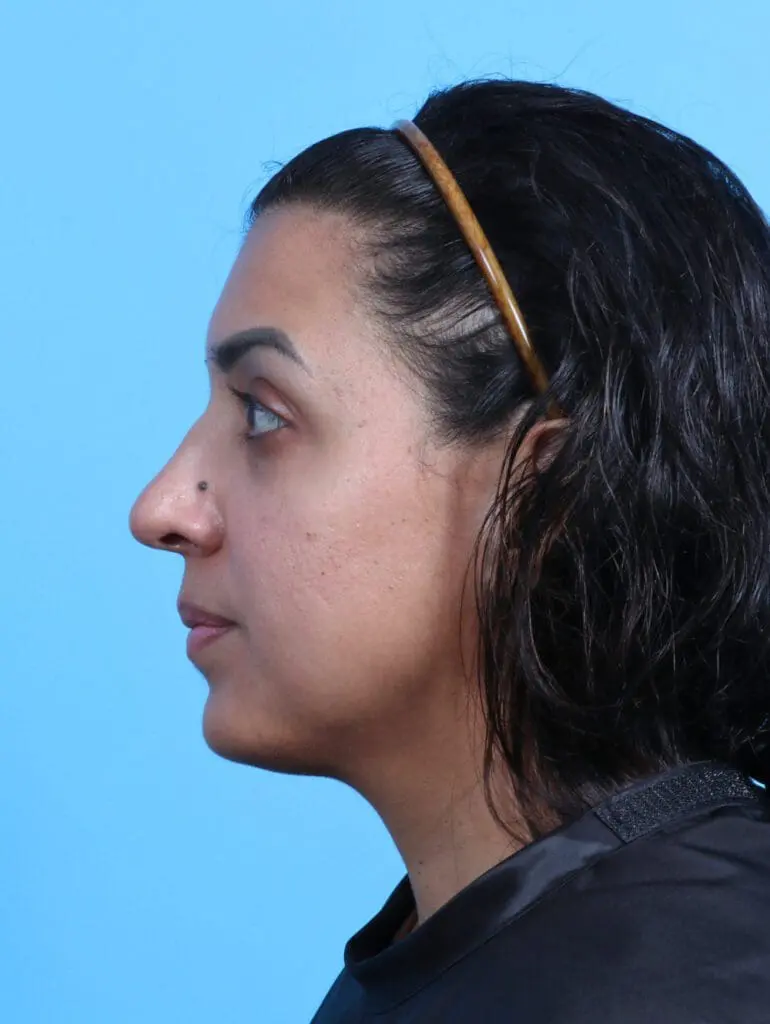 Rhinoplasty - Case 29233 - Before