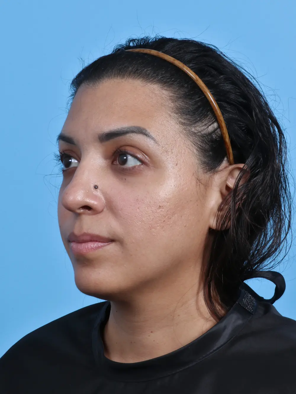 Rhinoplasty Patient Photo - Case 29233 - before view-1
