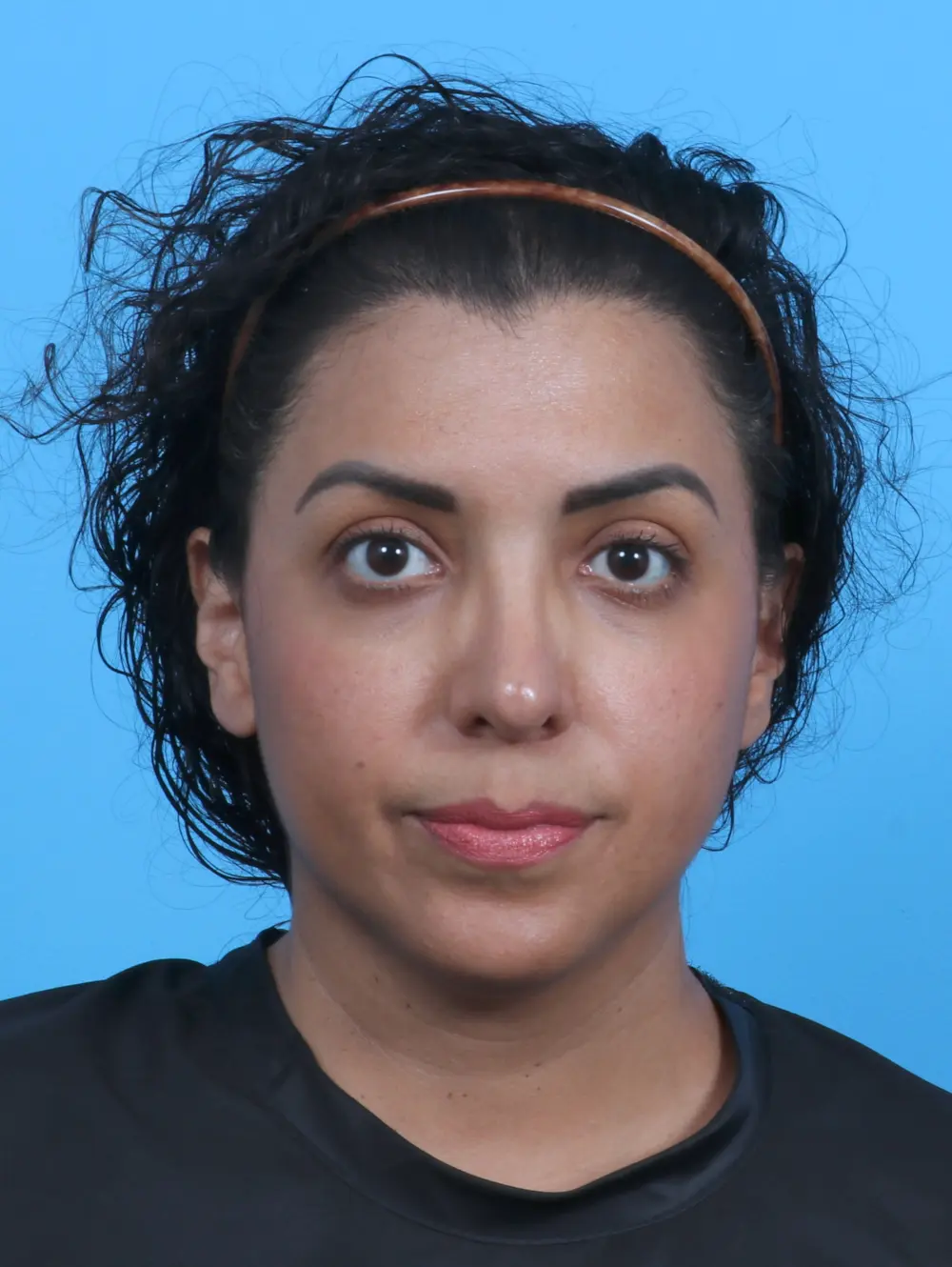 Rhinoplasty Patient Photo - Case 29233 - after view-2